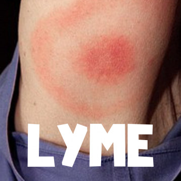 LYME – National Collaborating Centre for Infectious Diseases