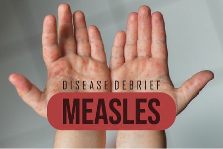 Measles