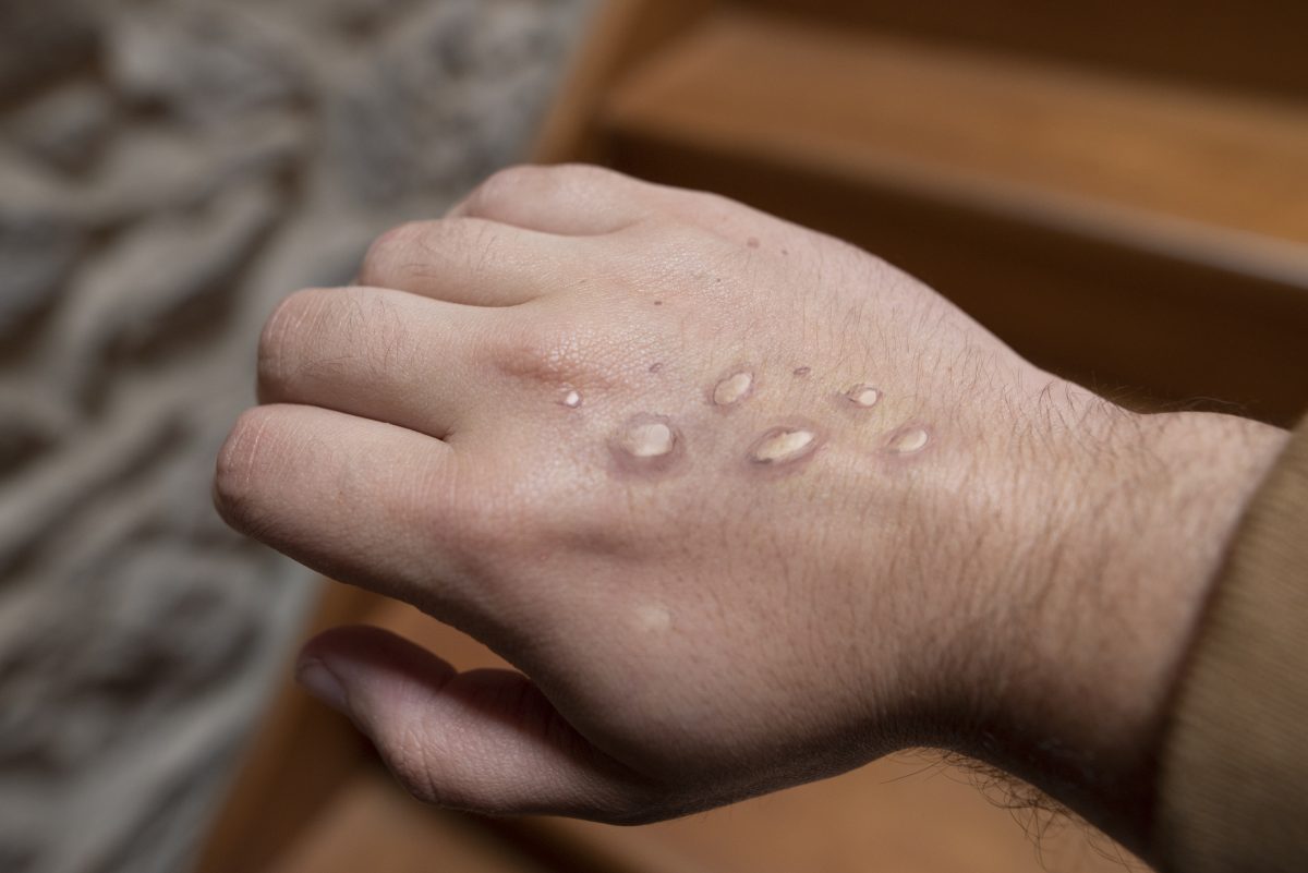 Rash on human hand depicting a Monkeypox infection